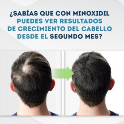 MINOXIDIL KIRKLAND CAJA X 6 UNIDADES DE 60 ML - Image 7