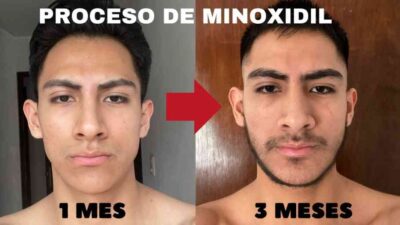 MINOXIDIL KIRKLAND CAJA X 6 UNIDADES DE 60 ML - Image 6